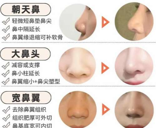 鼻修复