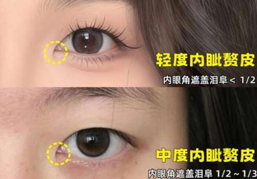 开眼角.jpg 开眼角.jpg