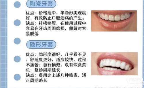 隐形牙齿