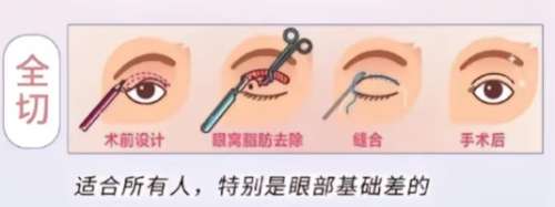 双眼皮 双眼皮