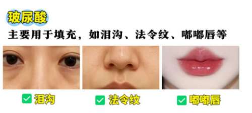 玻尿酸 玻尿酸