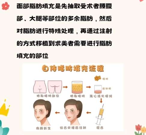 脂肪填充 脂肪填充