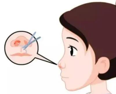 山东省千佛山医院安纲隆鼻怎么样 ?个人技术点评,隆鼻者可查看~