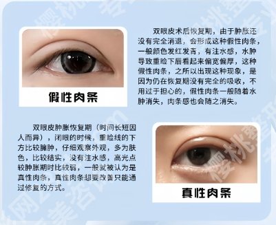 杭州姜鑫利医生怎么样?医生信息|真实双眼皮案例点评!就诊必看