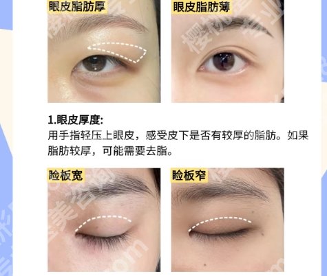 杭州姜鑫利医生怎么样?医生信息|真实双眼皮案例点评!就诊必看