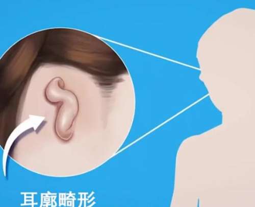 耳朵再造