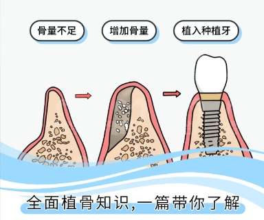 牙齿种植