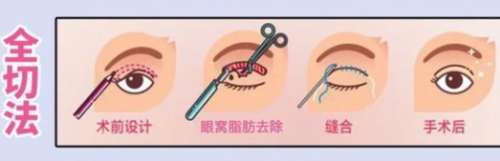 双眼皮