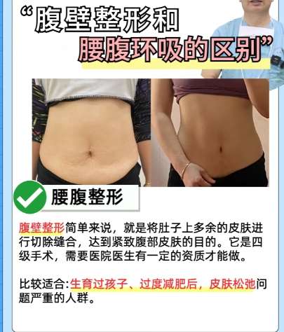 吸脂