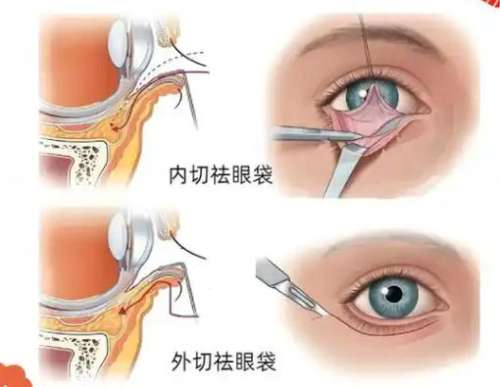 去眼袋