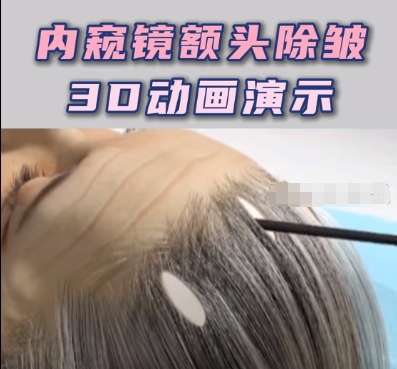 　　哈尔滨内窥镜额部除皱术多少钱?2万元左右起。在哈尔滨地区做内窥镜额部除皱手术的费用会受到多种因素的影响，所以价格方面不能够一概而论。内窥镜额部除皱手术，是改良抬头纹，皮肤松弛下垂等多种问题特别好的一种方法，但是此类手术需要到正规的医院去做，也需要一定的费用。关于哈尔滨地区做此类手术的费用，很多朋友都咨询过，今天就来给大家做介绍。  　　一、哈尔滨内窥镜额部除皱术多少钱  　　在哈尔滨地区做内窥镜额部除皱术，费用是2万元左右起不过费用会出现一定的浮动。做额部提升手术有多种方式可以达到手术目的，其中包括筋膜提升、拉皮除皱、埋线提升等等，不同的手术方式收费的标准不一样。另外，做此类项目需要选择正规医院，医疗机构的规模、等级和知名度，还有院内的医生级别，这些因素对于价格都会形成比较大的影响，所以价格不能一概而论!  　　想要咨询医院/预约医生，可以在【寻美整形网】点击咨询，进行详细咨询  　　二、哈尔滨内窥镜额部除皱术  　　1、哈医大一院整形美容外科  　　哈医大一院是哈尔滨地区特别值得选择的一家公立综合医院，做整形，这家的整形美容外科有着超强的实力水平。科室的建筑面积很大，有2500多平米，配备有4间符合国际标准的净化层流及手术室，还有多间，装修精良，舒适优雅的vip病房。该科室的热门项目有小切口额颞除皱手术、形体精雕，女性妇科整形、胸部整形和五官整形等等，在这家做过项目的小伙伴满意度超高，口碑也都特别好。  　　内窥镜额部除皱术多少钱：23,800元左右起  　　2、黑龙江超龙医疗美容医院  　　黑龙江超龙是在2019年成立的，营业空间有8000余平米，配备有多间层流级无菌净化手术室。一直以来都是严苛的把控质量关，所有的引进设备均有品牌授权，经过严格检测，使用的注射填充产品也都有cfda或欧盟ce认证。医资实力强大，每一位医生都是妥妥的科班出身，技术经经验足，审美在线，做项目能够结合个人的自身情况来制定合理方案，做完后状态自然，做表情不僵硬，没有假面感!  　　内窥镜额部除皱术多少钱：21,000元左右起  　　3、黑龙江瑞丽医疗美容医院  　　黑龙江瑞丽是黑龙江省内实力水平超强的一家私立专科机构，在2020年成立营业空间很大，有12,000余平米，设立科室完善，能开展项目种类超多，秉承着诚信规范的宗旨，为客户提供优质、合理、恰如其分的服务。从来不做过度营销，也没有乱收费现象，为客户提供的项目方案都符合客户的个人需求，做内窥镜额部除皱提升手术，技术也很棒。  　　内窥镜额部除皱术多少钱：2万元左右起