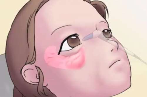 眼袋 眼袋