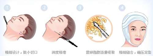 吸脂