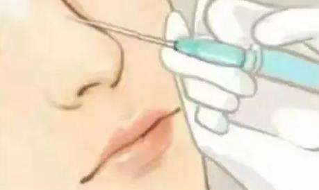 注射隆鼻