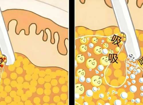 吸脂