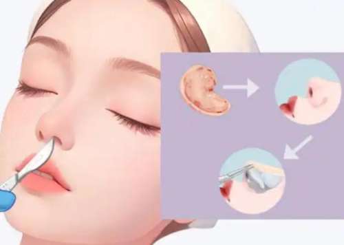 隆鼻 隆鼻