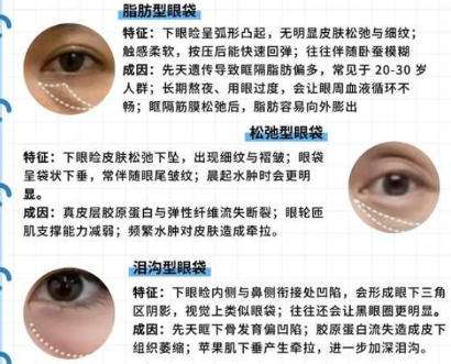 去眼袋 去眼袋