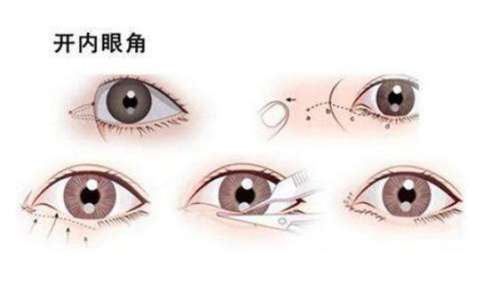 开眼角 开眼角