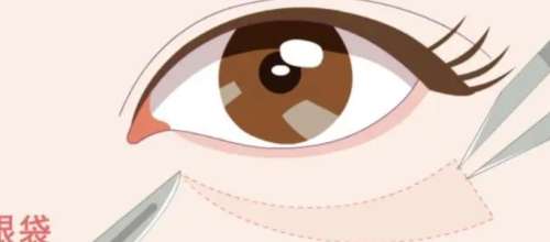 眼袋