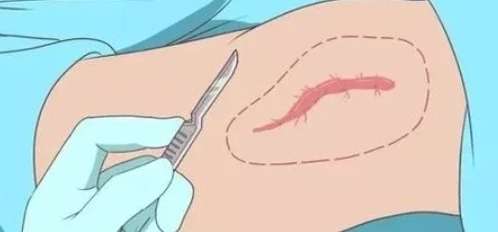 疤痕