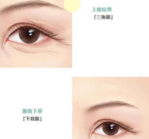 提眉 提眉