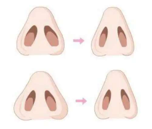 缩鼻翼 缩鼻翼