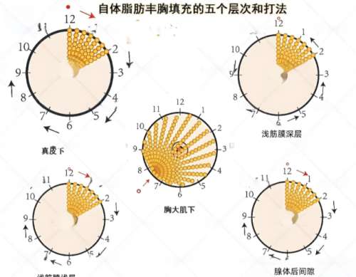 隆胸