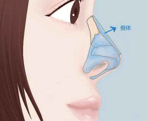 鼻假体取出