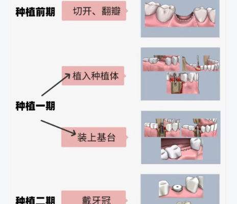牙齿种植