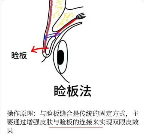 双眼皮