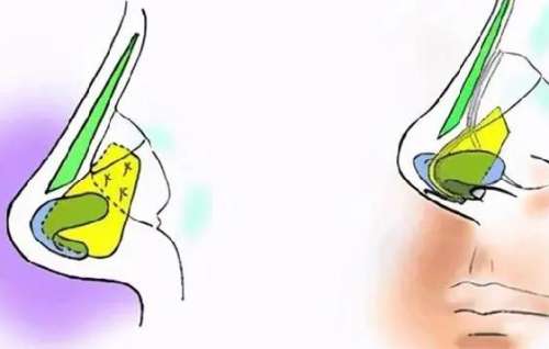隆鼻 隆鼻