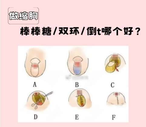 缩胸