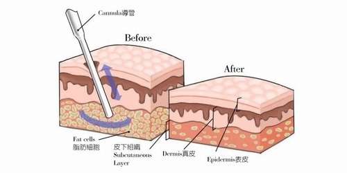 抽脂手术8.jpg