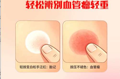 血管瘤1.jpg 血管瘤1.jpg