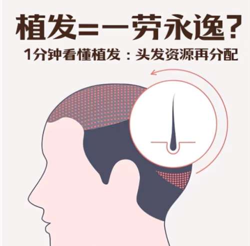 植发