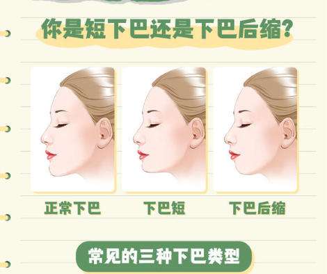 下巴后缩.jpg