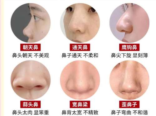 鼻修复 鼻修复