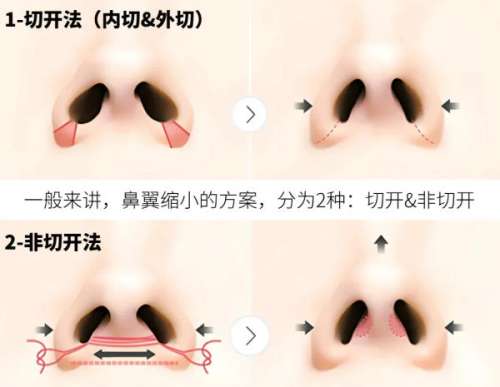 鼻翼缩小