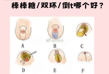 胸部悬吊术