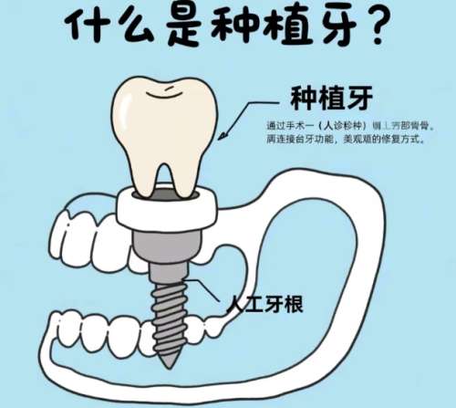 牙齿种植
