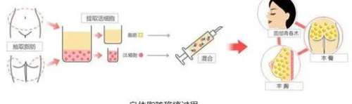 自体脂肪移植 自体脂肪移植