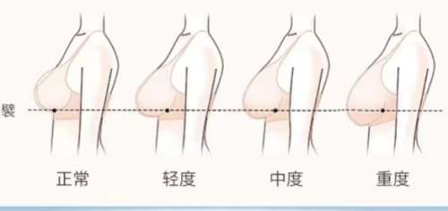 胸部悬吊术