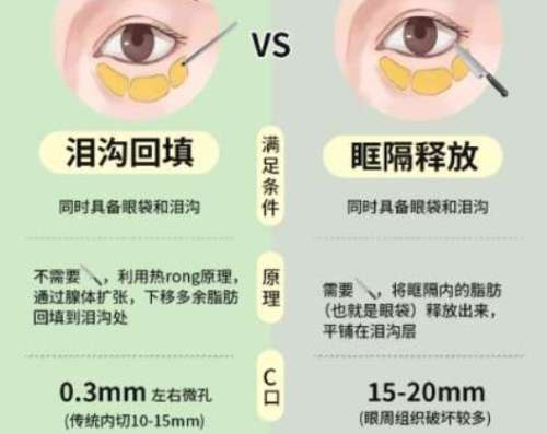 眼部脂肪填充 眼部脂肪填充