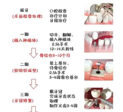 牙齿种植