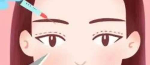 双眼皮 双眼皮