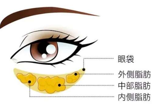 去眼袋-结构.jpg