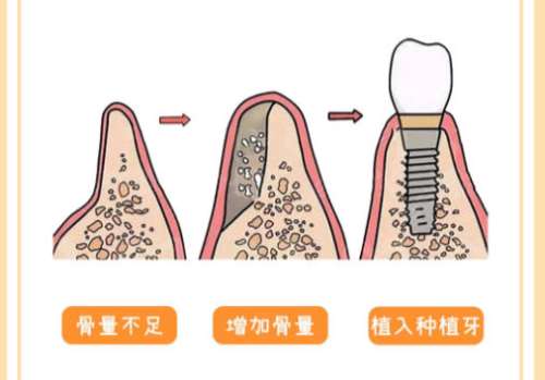 种牙7.jpg