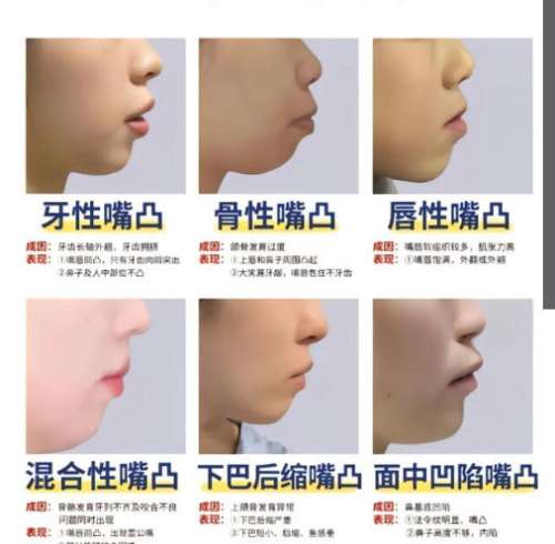 下巴后缩2.jpg