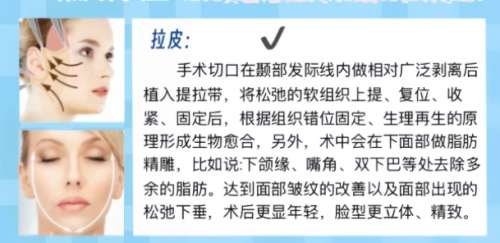 拉皮