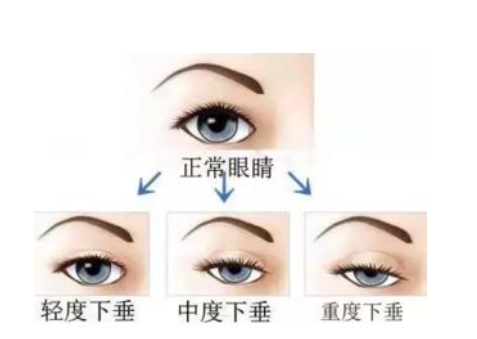 双眼皮修复1.png